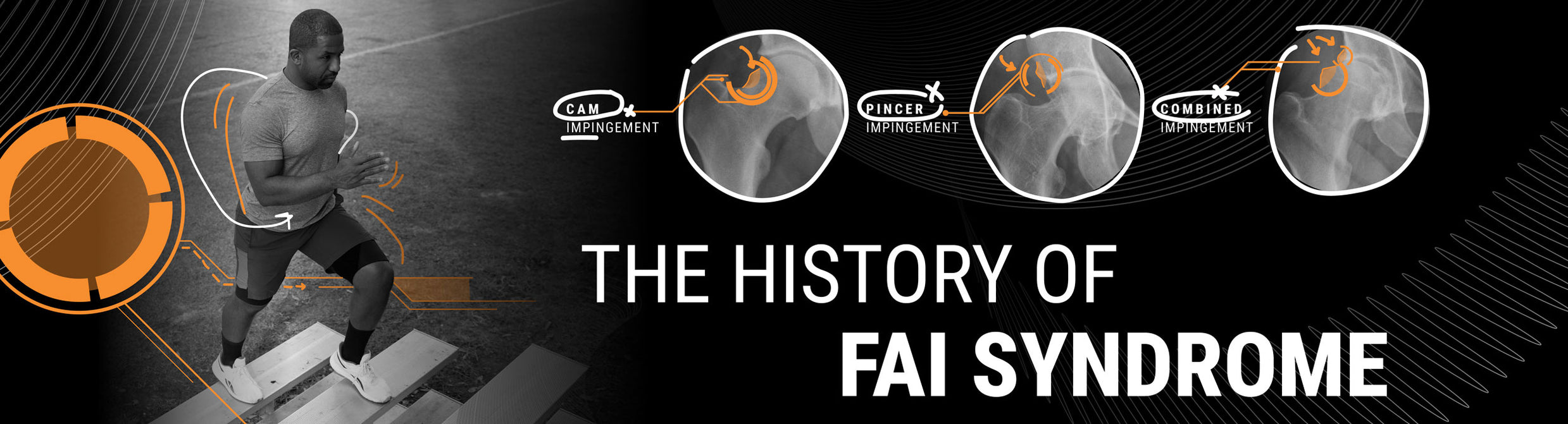 The History of Femoroacetabular Impingement (FAI) Syndrome | SAFS Shorts