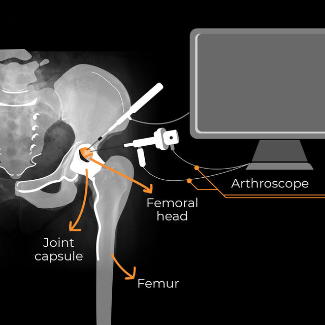 Femoroacetabular Impingement (FAI) arthroscopy - minimally invasive surgical procedure