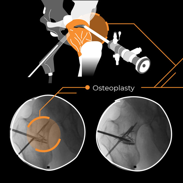 Surgical interventions for Femoroacetabular Impingement (FAI)